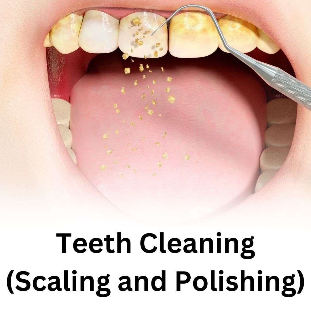teeth-clea_17354514275hCqYh.jpeg
