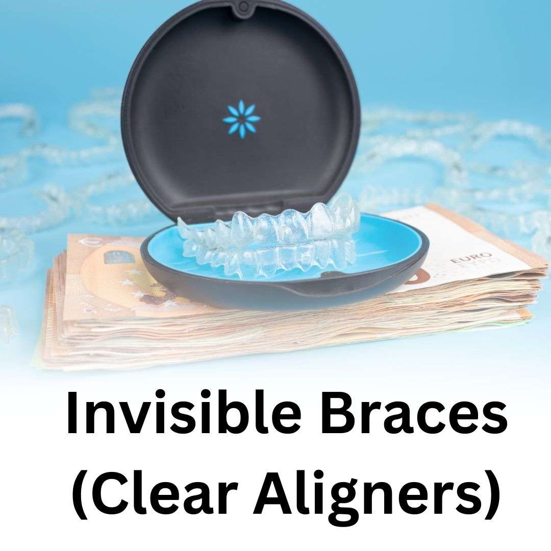 Invisible Braces (Clear Aligners)