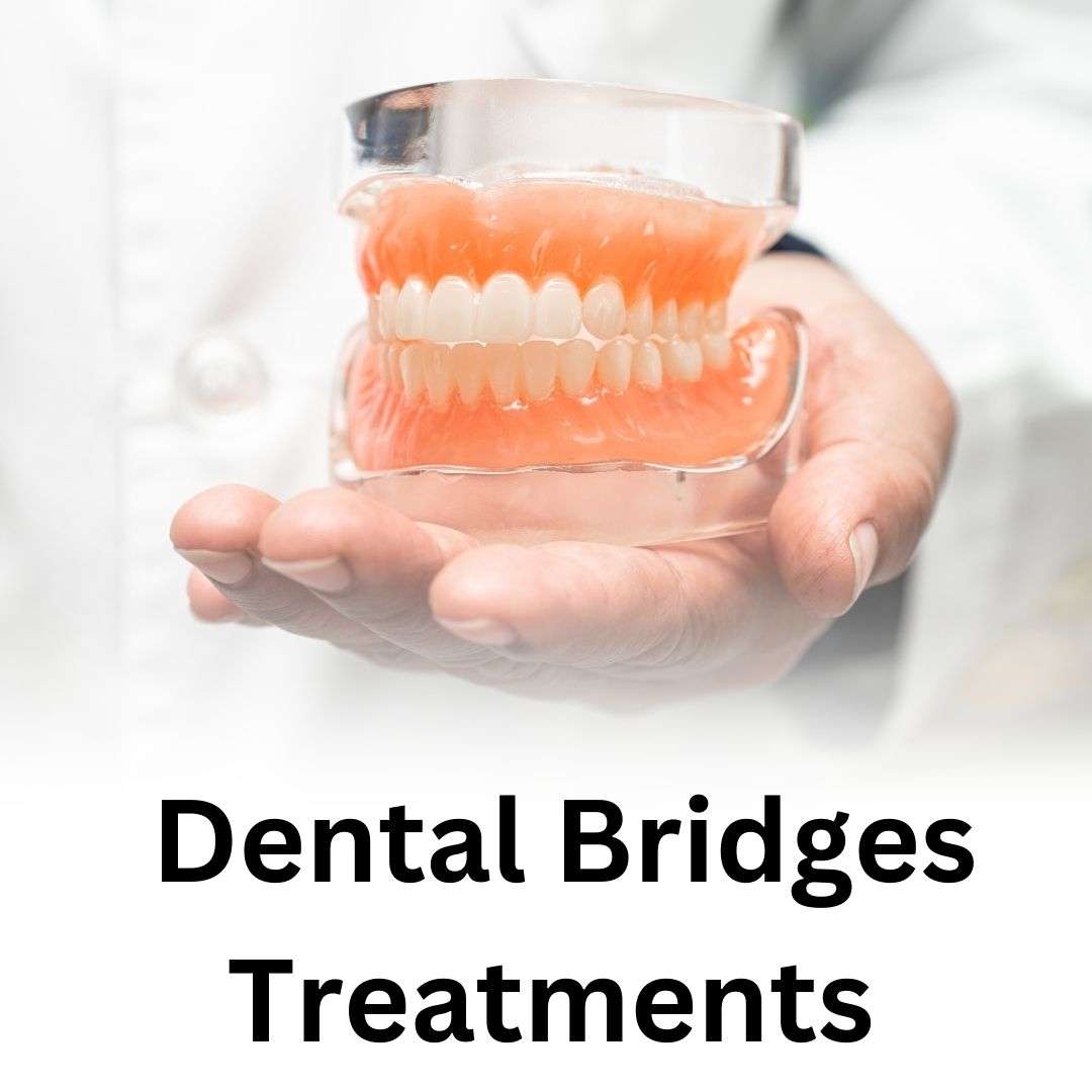 Dental Bridges