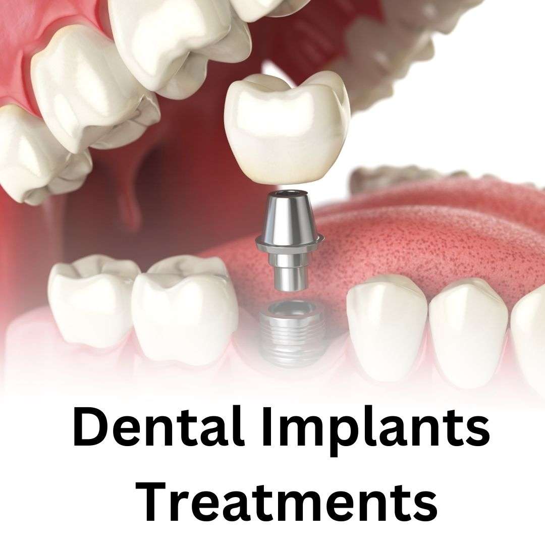 Dental Implants