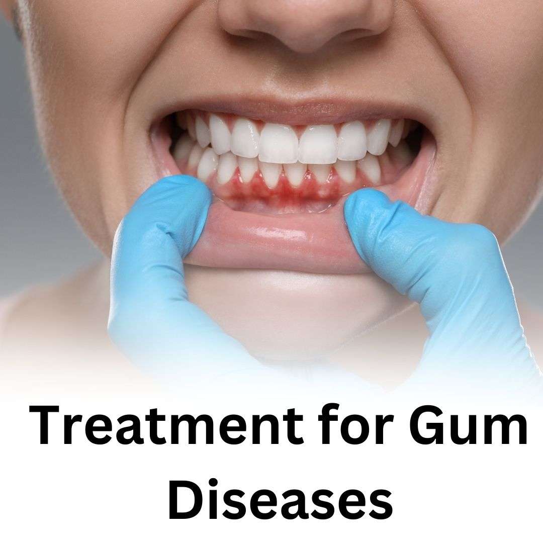 Treatment for Gum Diseases