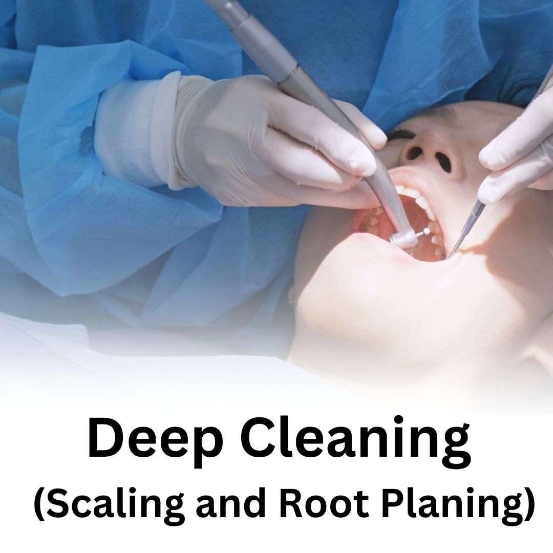 Deep Cleaning (Scaling and Root Planing)