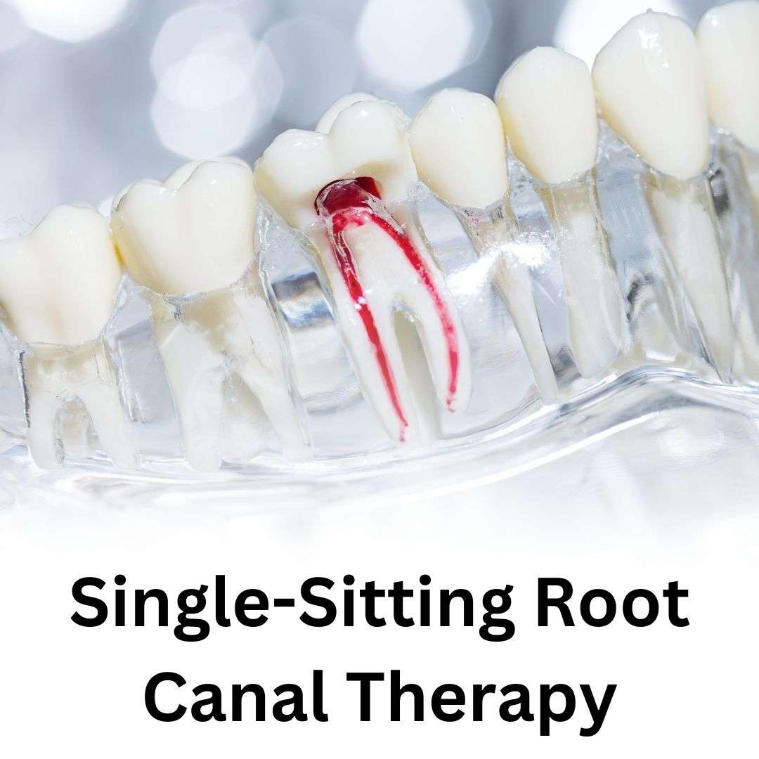 Single-Sitting Root Canal Therapy