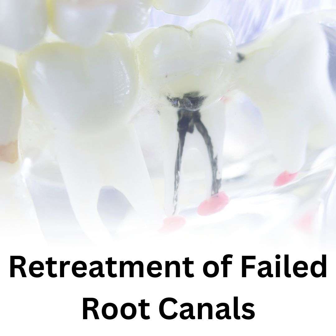 Retreatment of Failed Root Canals