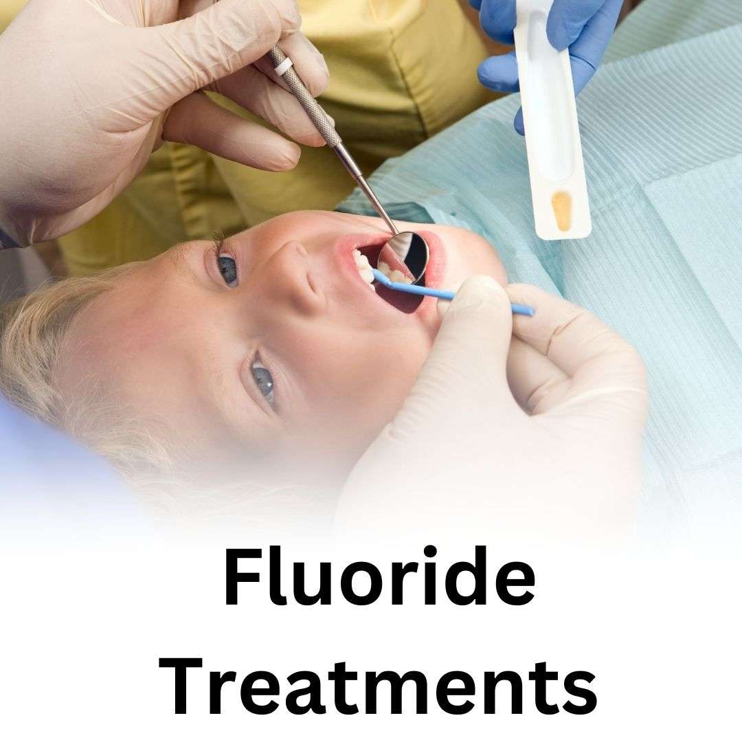 Fluoride Treatments